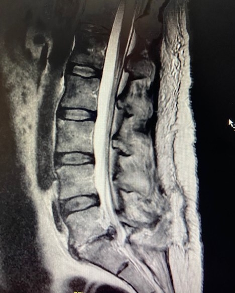 Radiology case #1_discitis