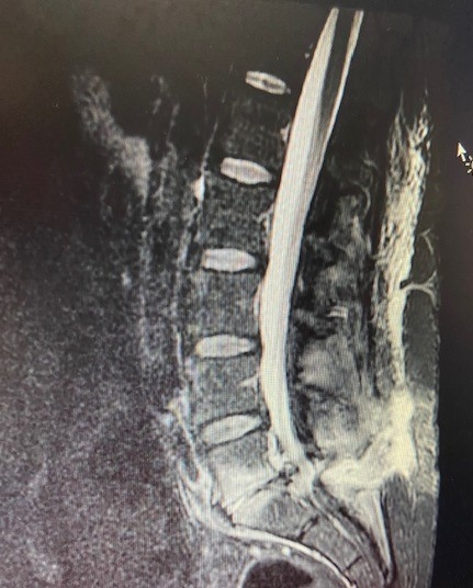Radiology case #1_image2 Stir Sequence Discitis