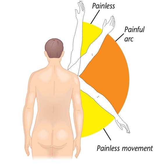 CotM #34 impingement syndrome